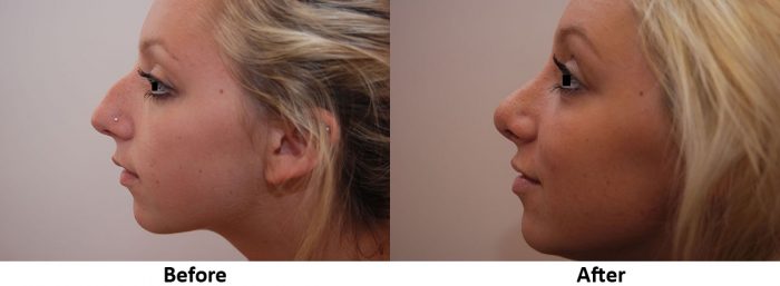 Chin Implant Before and After.