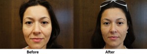 Under-Eye-and-Pre-Jowl-Before-After1