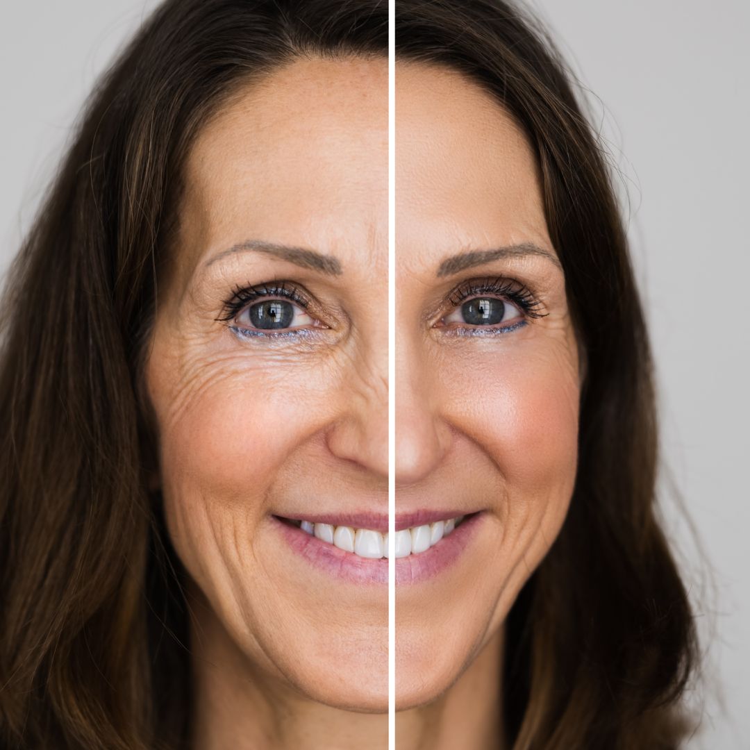 Before and after image of a brow lift